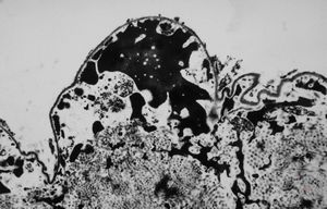 M,63y. | dystrophic calcification in plexus chorioides M,63y. | dystrophic calcification in plexus chorioides
